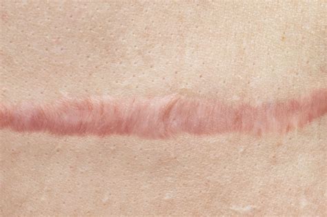 Topical Treatments For Keloids And Hypertrophic Scars Lack Widespread