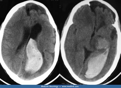 Traumatic Intracerebral Hemorrhage Medlink Neurology