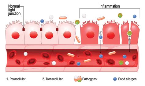 Leaky Gut What It Is And How To Heal It Gastroenterology Consultants