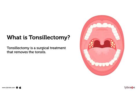 Tonsillectomy Treatment Procedure Cost Recovery Side Effects And More