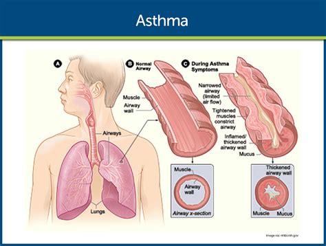 asthma pathophysiology