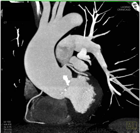 Aortic Valve Calcification With Aortic Stenosis And Dilated Ascending