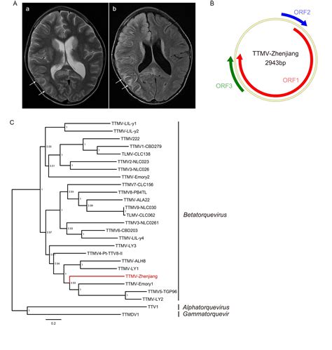 Identification Of A Novel Torque Teno Mini Virus In Cerebrospinal Fluid