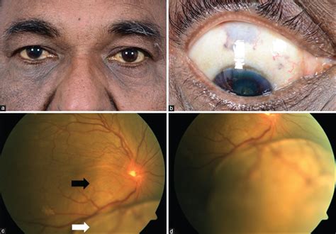 Multifocal Choroidal Melanoma In Oculodermal Melanocytosis In An Asian
