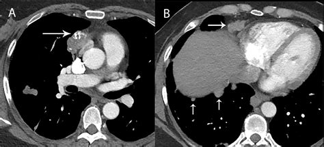 Frontiers Imaging Evaluation Of Thymoma And Thymic Carcinoma
