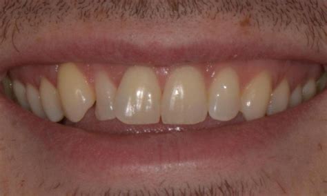 Before And After Teeth Whitening Brisbane Cosmetic Dentistry