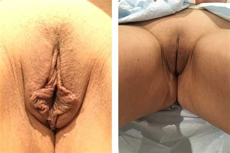 Labiaplasty Gallery Before After Labiaplasty Providence RI