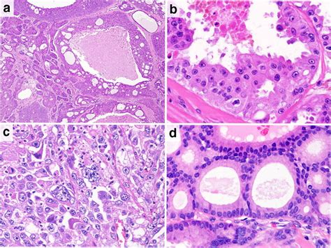 Representative Histologic Features Of Salivary Duct Carcinoma Sdc A