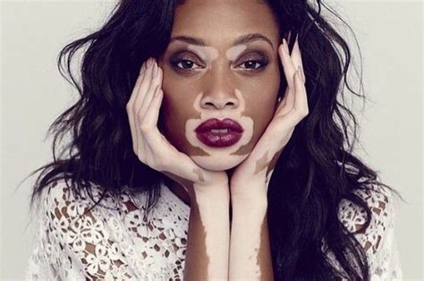 23 Photos Qui Montrent Le Vitiligo Sous Un Autre Jour Vitiligo