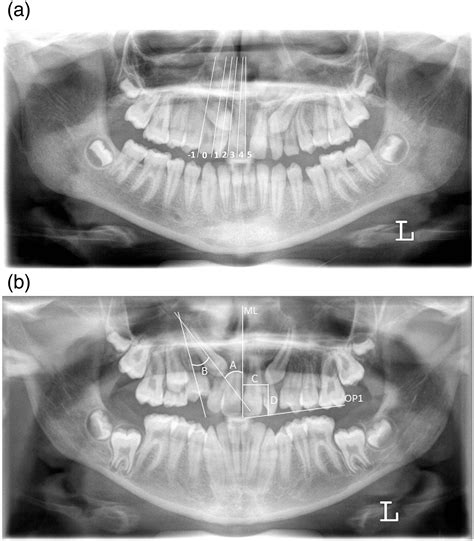 Prediction Of Maxillary Canine Impaction Based On Panoramic Radiographs