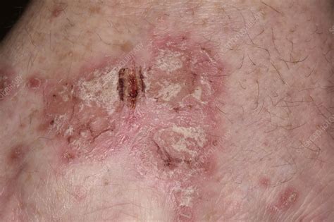 Plaque Psoriasis Stock Image C0473000 Science Photo Library
