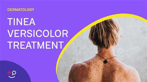 How To Diagnose And Treat Tinea Versicolor