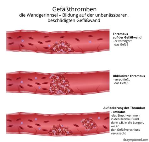 Blutgerinnsel in arm oder bein, tiefe venenthrombose (tvt). Thrombose - Symptome
