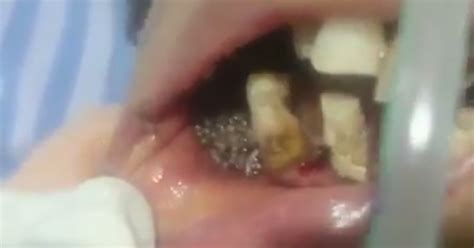 What to do if you find a maggot in your house? Video Shows Dentist Removing Maggots From Woman's Gums
