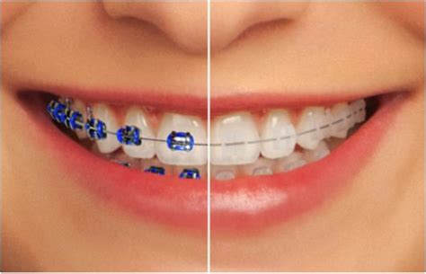 Dan adik ipar nad baru je buka braces dia bulan oktober 2017. ¿Qué tipos de ortodoncia existen? - Clinica Dental Centro ...