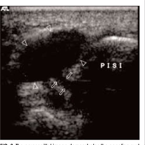 Figure 2 From Musculoskeletal Images Ganglion Cyst Of Guyon S Canal