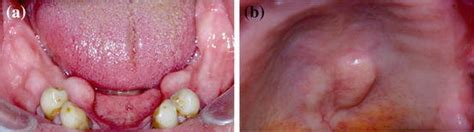 A Exostosis Or A Torus On The Lingual Side Of Mandibular Premolars B