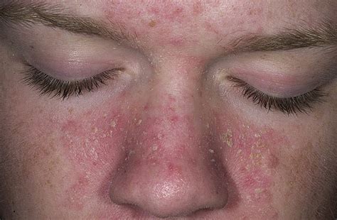 Exposed Seborrhea Dermatitis And Seborrhea Conditions Treatment