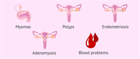 Why Do Blood Clots Occur During Menstruation