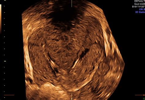Didelphys Uterus With Ct Mri Correlation Radiology
