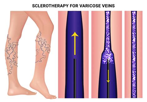 Sclerotherapy For Varicose Veins In Nyc And Nj Vein Care Center