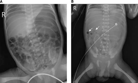 Abdominal X Ray Findings Of The Neonatal Gastric Perforation Before And Download Scientific