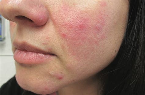 Rosacea Presents With Erythematous Facial Papules And Pustules The