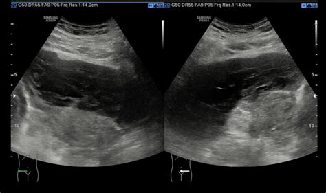 Ultrasound Abdomen Show Complex Ascites Download Scientific Diagram