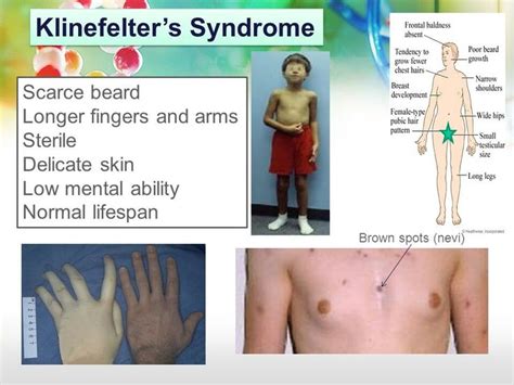 klinefelter syndrome infogram charts and infographics images and photos finder