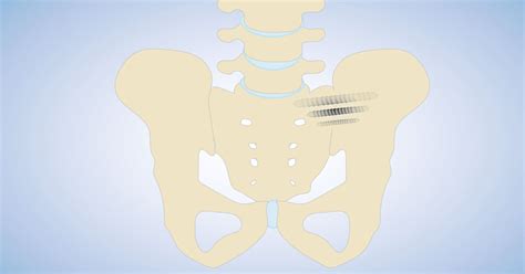 Sacroiliac SI Joint Fusion Seattle WA Brain And Spine Surgery