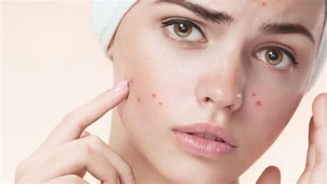 What Causes Acne On Face Foods To Avoid Pimples On The Face Psyspeaks
