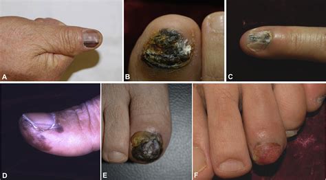 Nail Apparatus Melanoma A Comparative Clinicoprognostic Study Of The