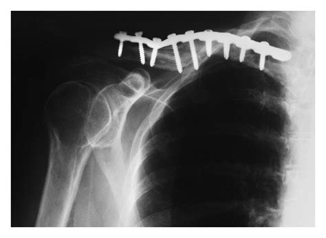 Radiograph Of The Right Clavicle With Fracture Fixation Plate And