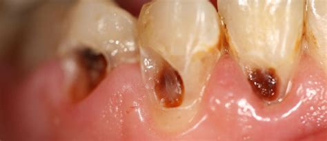 Gv Blacks Classification Of Carious Lesions Caries Dentalnotebook