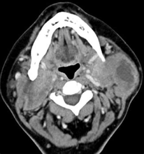 Cect Head And Neck Showing Necrosis In Parotid And Bilateral Cervical