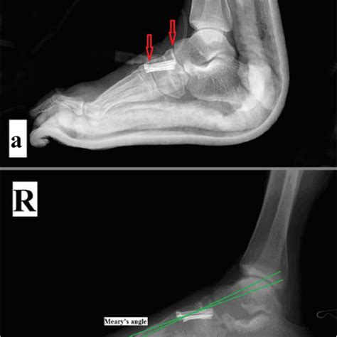 Preoperative Plan Measurement Of Mearys Angle Calcaneal Pitch Angle