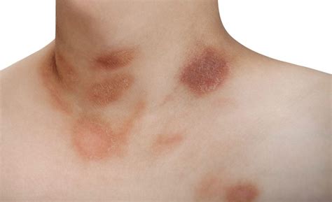 What Is Pityriasis Rosea Symptoms And Treatment