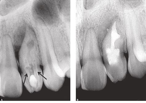 Figure From Management Of A Rare Case Of Class II Double Dens