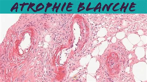Atrophie Blanche Livedoid Vasculopathy Dermatology Dermpath