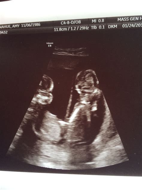 16 Weeks Pregnant Ultrasound