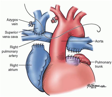 Tricuspid Atresiasingle Ventricle And The Fontan Operation Thoracic Key