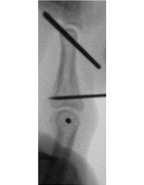 Indirect Fixation Of A Palmar Fragment With A K Wire Download