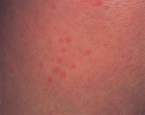 Cholinergic Urticaria Causes Diagnosis Treatment And Prevention