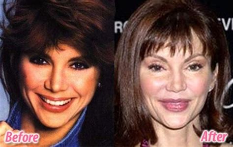 Stars before and after plastic surgery (47 pics ...