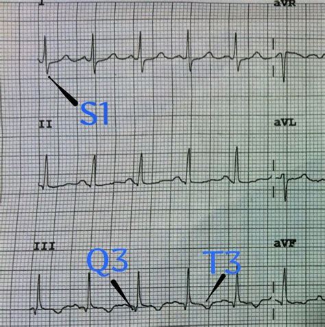 S1q3t3 Ekg Classic Pattern In Pulmonary Embolism Example Pulmonary