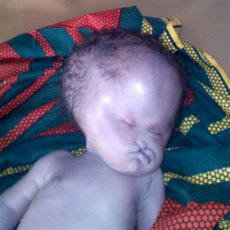 See The Photo A Facebook User Shared Of A Deformed Baby Due To Use Of