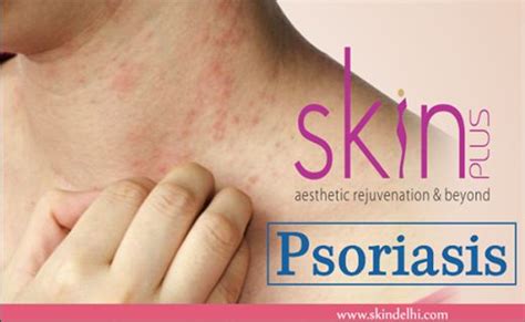 Psoriasis Is A Chronic Disorder That Is Genetic And Not Contagious