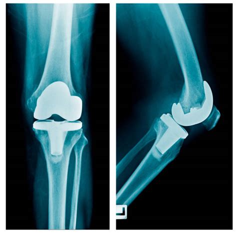 Find knee replacement on topsearch.co. Knee Arthroplasty Stock Photos, Pictures & Royalty-Free ...