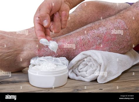 Psoriasis Is A Chronic Inflammatory Disease Of The Skin Treatment Of