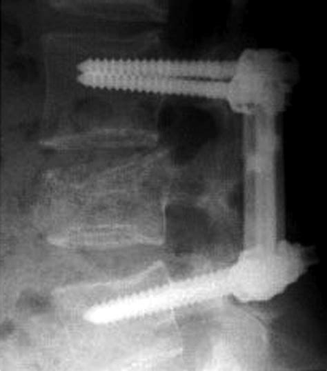 List 93 Pictures Lumbar Spinal Fusion Surgery Pictures Updated